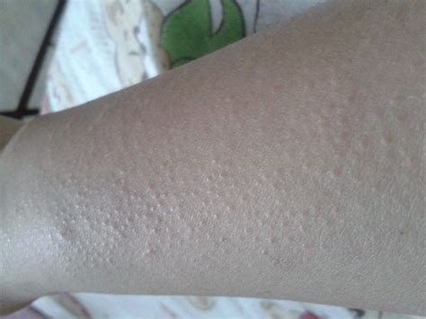 胳膊上长了个肉疙瘩胳膊上长了个肉疙瘩不痛不痒2022已更新今日图集