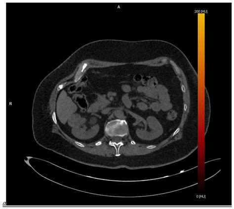 Update on Renal Cell Carcinoma Diagnosis with Novel Imaging Approaches