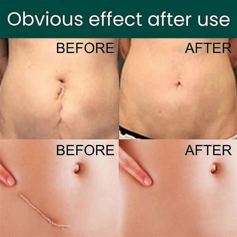 Tummy Tuck Scar