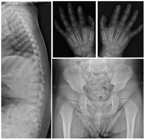 Newborn Screening Program for Mucopolysaccharidosis Type II and Long ...
