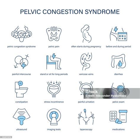 Pelvic Congestion Syndrome Nice – ITZNS