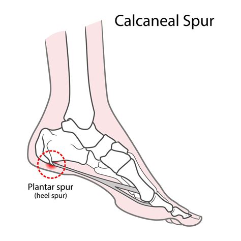 Calcaneal Spur treatment – HappyWalk - Orthopedic & Diabetic Footwear Store
