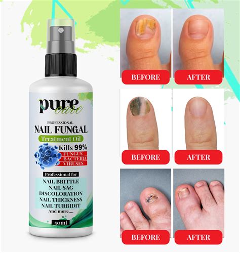 Nail Fungus Treatment Ratings at Victoria Horton blog