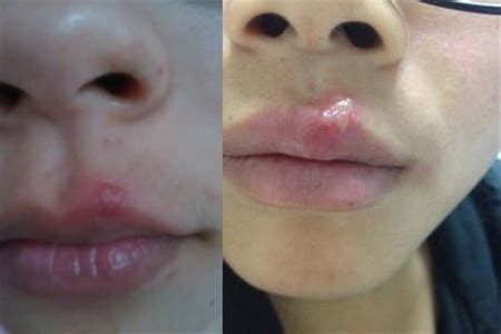 【图】上嘴唇长痘痘是什么原因 该如何去除痘痘呢(3)_伊秀美容网|yxlady.com