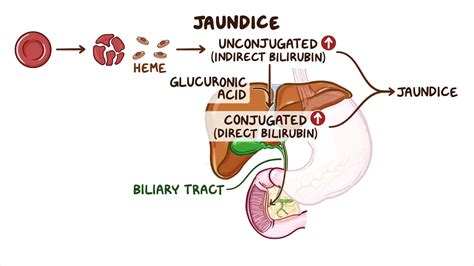 Differential Diagnosis Unconjugated Hyperbilirubinemia at Bruce Conti blog