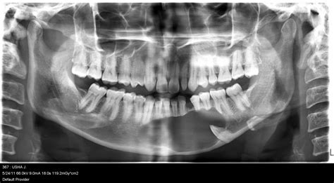 Adenomatoid Odontogenic Tumor in the Mandible: A Case Report