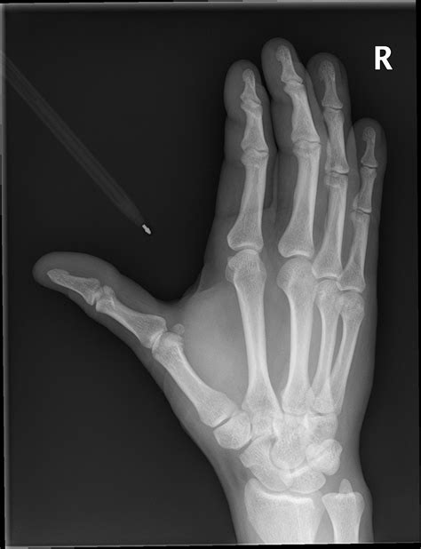 Normal Hand X Ray