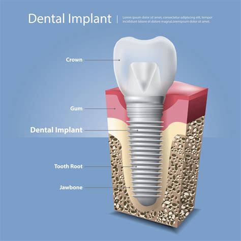 The Anatomy of The Dental Implant | Knoxville TN Dentist