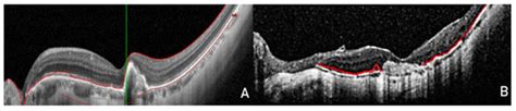 OCT Analysis of Retinal Pigment Epithelium in Myopic Choroidal ...