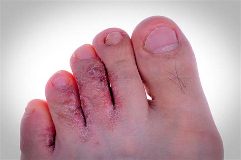 Hongos | Pie Atleta | Dermatomicosis - Clínica del Pie Embajadores