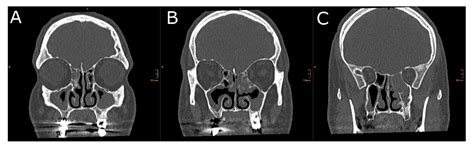 Radiological Markers of the Olfactory Cleft: Relations to Unilateral ...