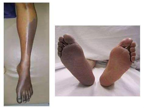 Acute limb ischaemia | PPTX