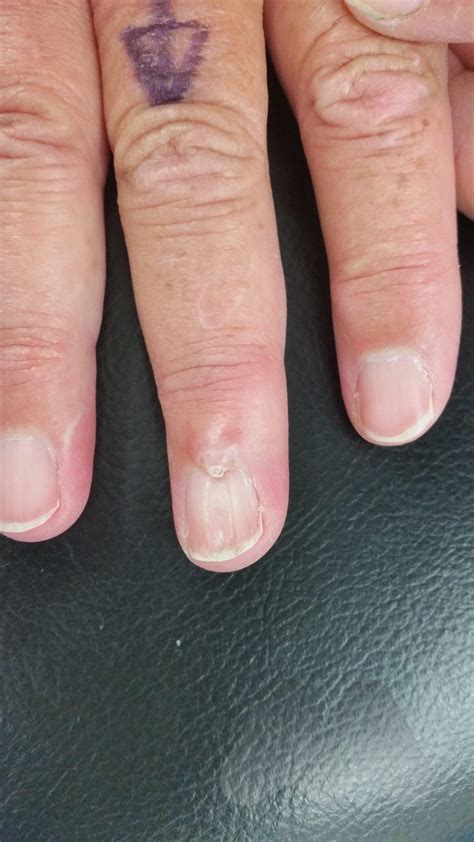 Mucous cysts - Avanthi Mandaleson