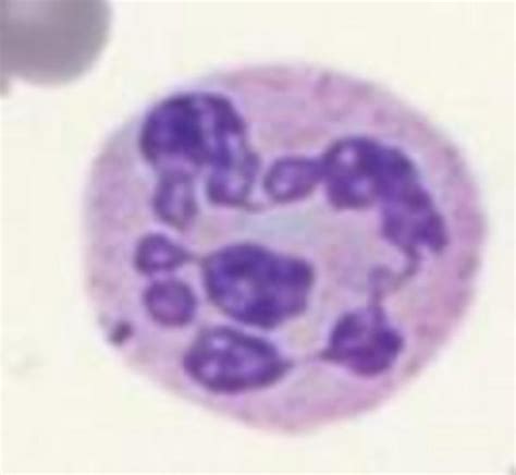 Essential Thrombocythemia, Iron Deficiency - Morphology QSP Newsletter ...