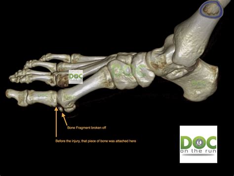 Hairline Fracture Big Toe