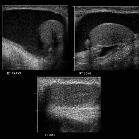 Pediatric Hydrocele | Pediatric Radiology Reference Article | Pediatric Imaging | @pedsimaging