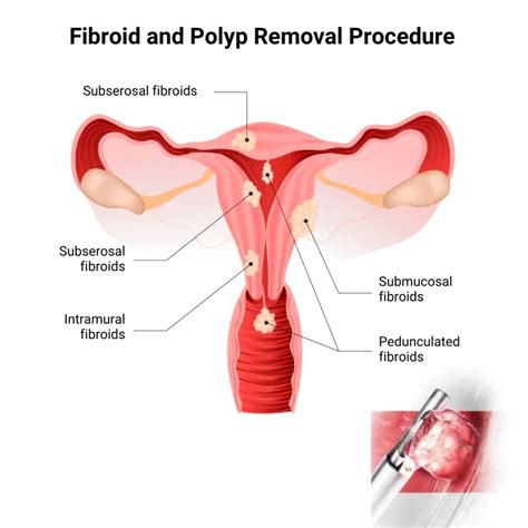 Recovering From Uterine Polyp Removal: What To Expect