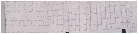 Diagnostic Pitfalls of Prosthetic Valve Endocarditis: From Sacroiliitis ...