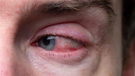 Eye-Related Staph infections