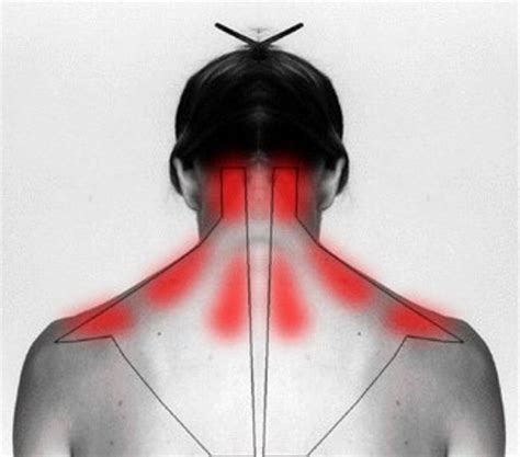 Can Headaches Cause Neck Stiffness at James Marts blog