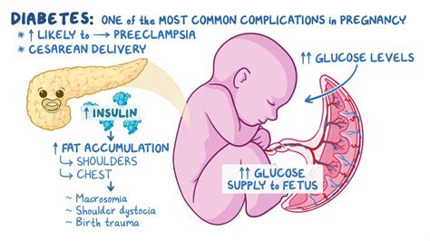 Video: Approach to diabetes in pregnancy: Clinical sciences | Osmosis