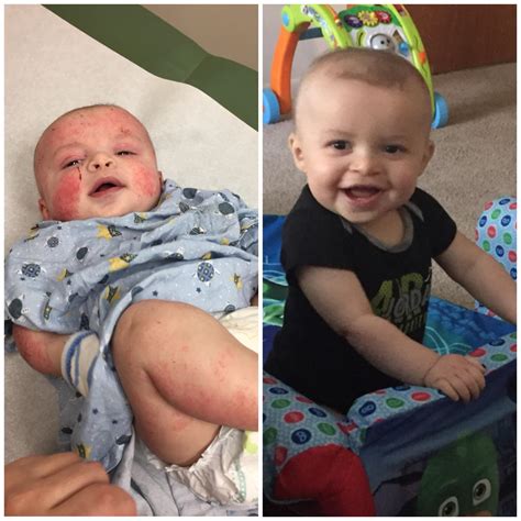 10 months ago my son’s entire body was covered in eczema and he was ...