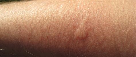 Kako razlikovati ugriz stjenice od ostalih kukaca: Mogu izazvati osip ...