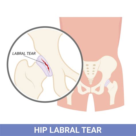 Fast Relief from Hip Labral Tear Pain in Ottawa | Canadian Private ...