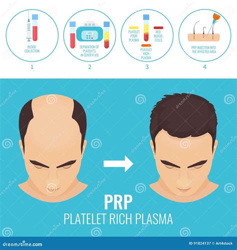 Man before and after RPR Therapy Stock Vector - Illustration of medical, plasma: 91824137