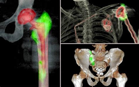 Avance en el diagnóstico con el SPECT-TAC | Tu canal de salud