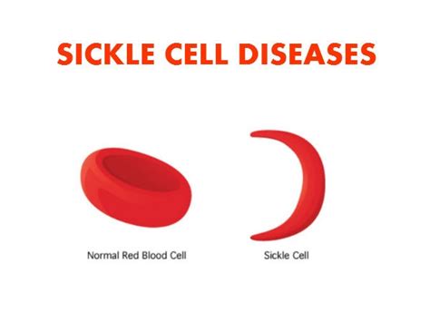 What is Sickle Cell Diseases | Healthy Living