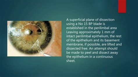 Recurrent corneal erosions and ptk | PPTX