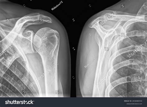 Scapula Bone Anatomy X Ray at Beth Barnard blog