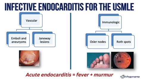 Pathophysiology of Infective Endocarditis for the USMLE : r/step1