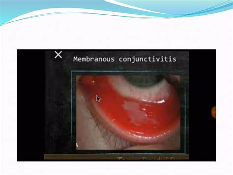 Gram positive bacteria in ocular pathology | PPTX