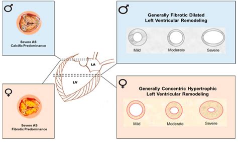 IJMS | Special Issue : Calcification in Human Pathology