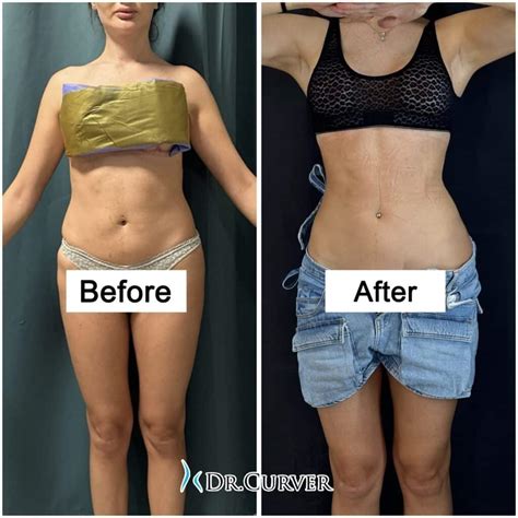 Image result for First Rib Resection Surgery