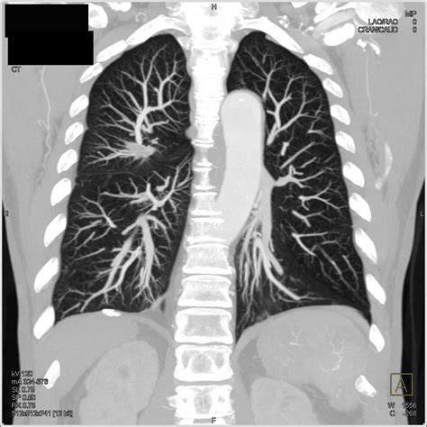 Incidental Scar Carcinoma Right Lung - Chest Radiology Case Studies - CTisus CT Scanning