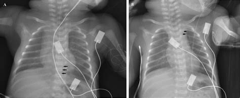 A Preterm Newborn With the “Barrel Syndrome” - Pediatric Neurology
