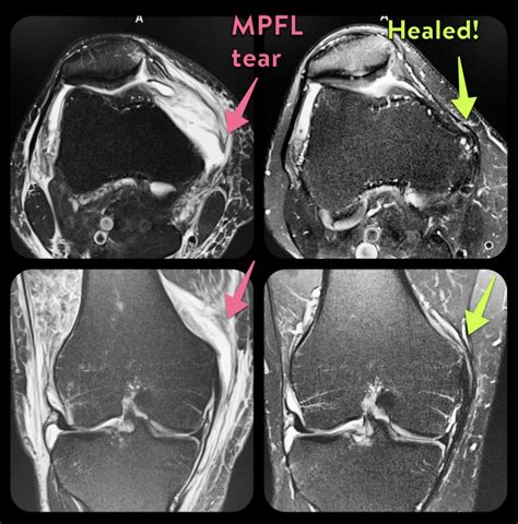 Medial Patellofemoral Ligament