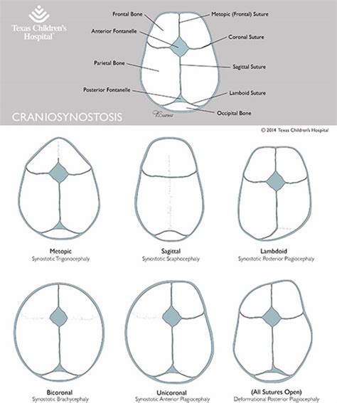 Craniosynostosis | Texas Children's