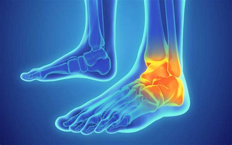 What is Sprained Ankle? What are its Symptoms, Causes and Treatment?