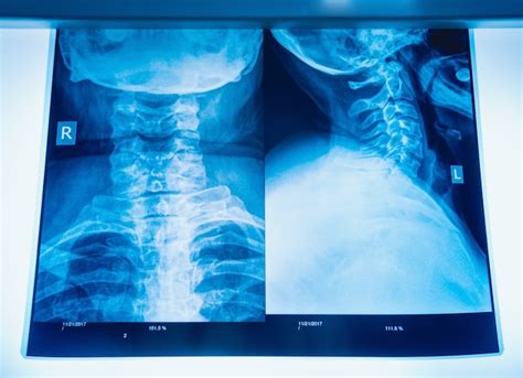 Image result for Neck X-Ray