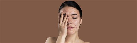 SCARS & HYPERPIGMENTATION – Looks Kart