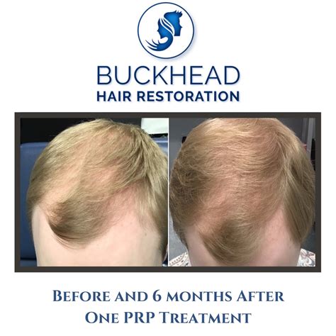 PRP Hair Treatment: How It Works and What to Expect