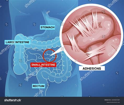 Bowel Obstruction Adhesions Fibrous Bands That Stock Vector (Royalty Free) 2403647287 | Shutterstock