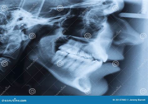X-ray Lateral Cephalometric Film Stock Image - Image of diagnose ...