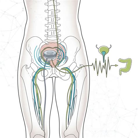 Stunning Benefits of Sacral Nerve Stimulation for Healthcare Professionals