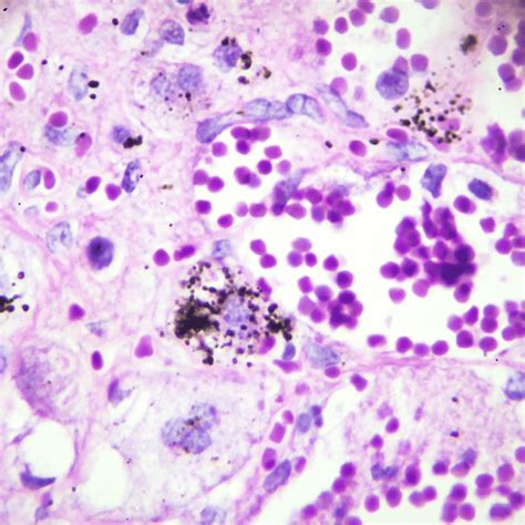 Pathology Reports: Info from National Cancer Institute - Paula Takacs Foundation