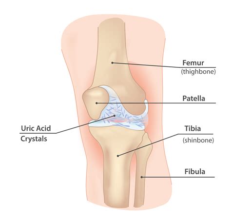 Gout Knee